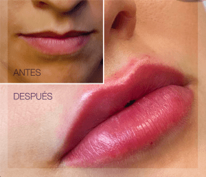 aumento de labios en la feminización facial