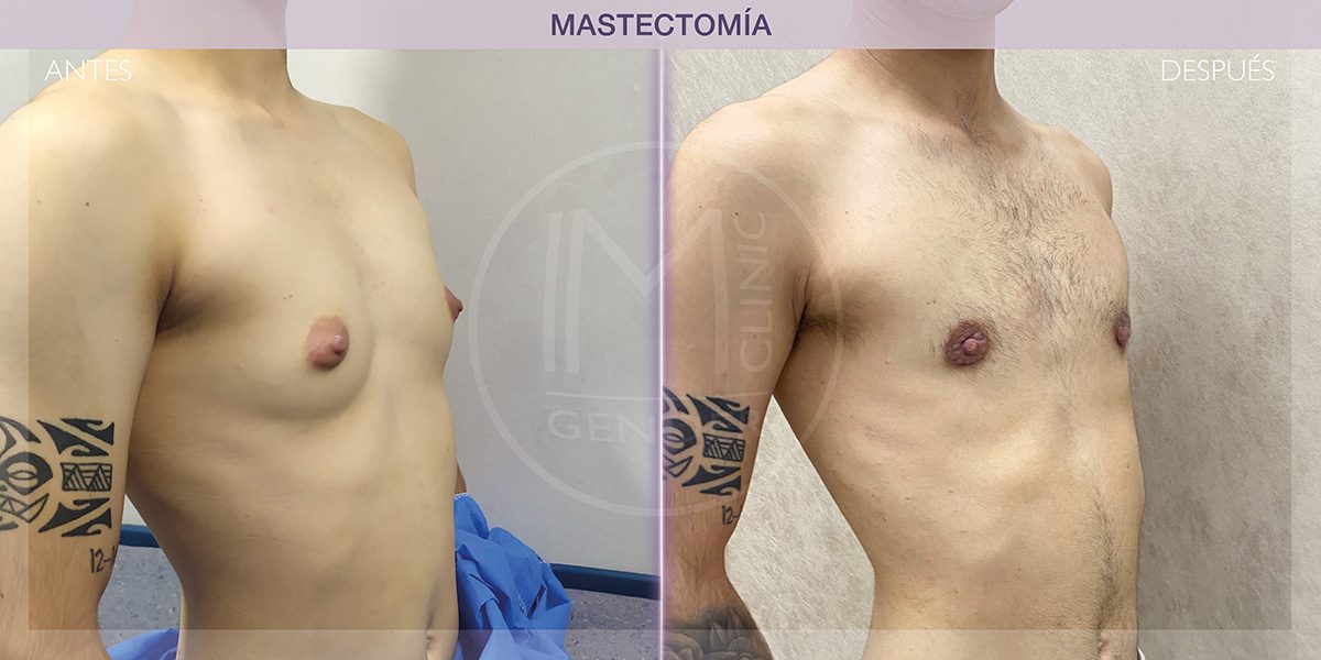 Female to male TOP Surgery result After 13 days