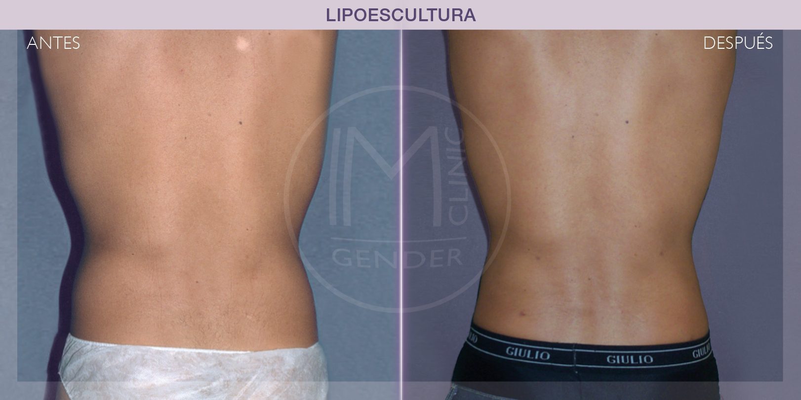 FTM Liposuction, Transgender Liposuction