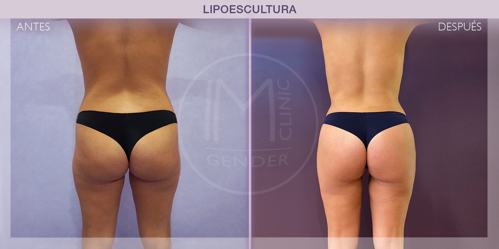 MTF Liposuction, Transgender Liposuction