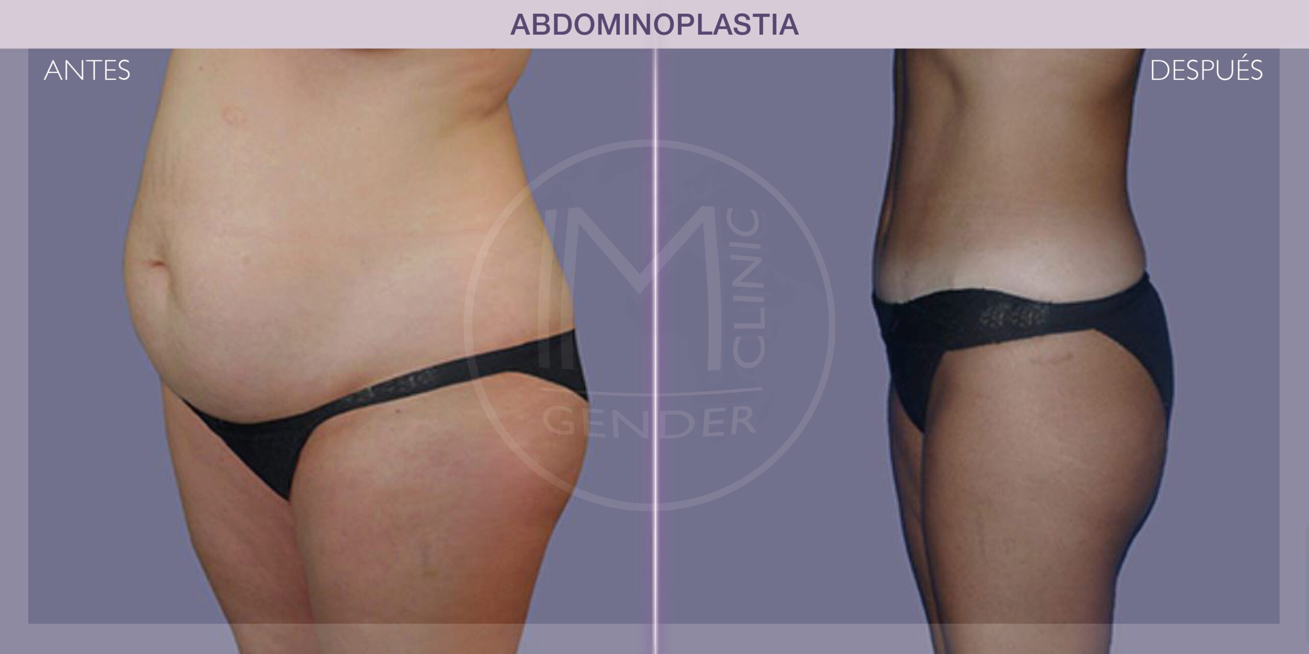 Abdominoplasty Results - IM CLINIC