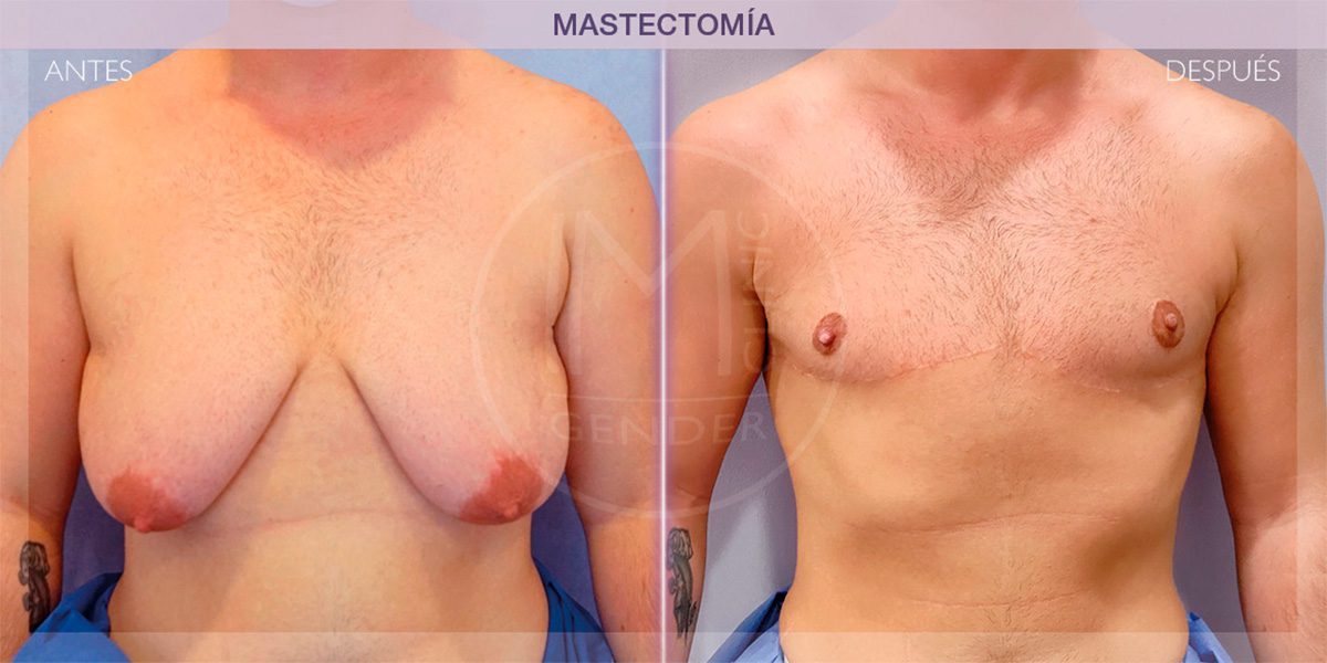 A, Breast appearance before transgender top surgery. B, Results