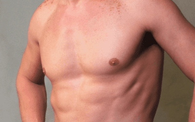 Mastectomía en hombres: la cirugía más demandada