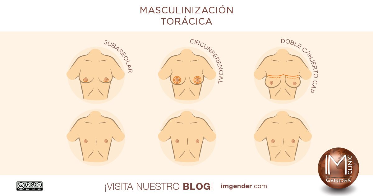 Infografica mastectomía trans